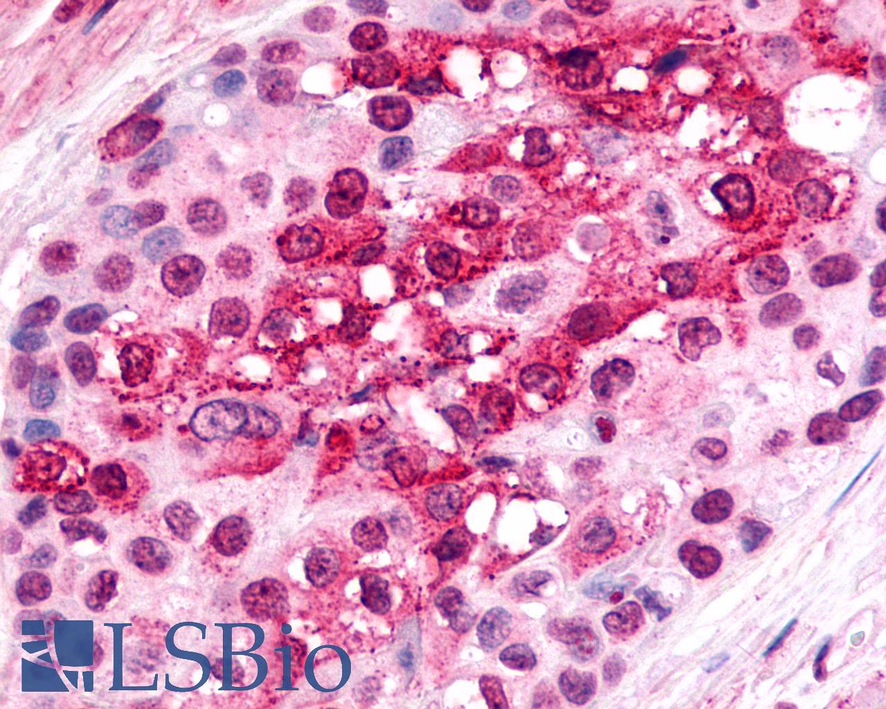 CXCR6 Antibody - Anti-CXCR6 antibody IHC of human Breast, Carcinoma. Immunohistochemistry of formalin-fixed, paraffin-embedded tissue after heat-induced antigen retrieval.