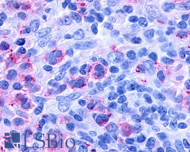 CYSLTR1 / CYSLT1 Antibody - Anti-CYSLTR1 / CYSLT1 antibody IHC of human Lymph Node, Hodgkins Lymphoma. Immunohistochemistry of formalin-fixed, paraffin-embedded tissue after heat-induced antigen retrieval.