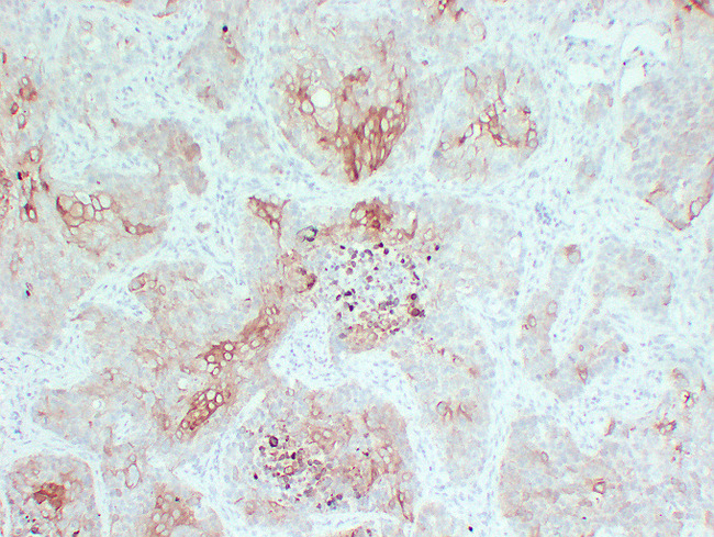 Cytokeratin 5+6 Antibody - Lung Squamous Carcinoma