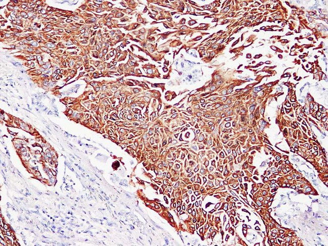 Cytokeratin 5+6 Antibody - Squamous Cell Lung Carcinoma