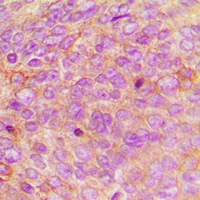 DEFA1 / Defensin Alpha 1 Antibody - Immunohistochemical analysis of Defensin alpha 1 staining in human breast cancer formalin fixed paraffin embedded tissue section. The section was pre-treated using heat mediated antigen retrieval with sodium citrate buffer (pH 6.0). The section was then incubated with the antibody at room temperature and detected using an HRP conjugated compact polymer system. DAB was used as the chromogen. The section was then counterstained with hematoxylin and mounted with DPX.