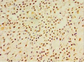 DEFB4A / BD-2 Antibody - Immunohistochemistry of paraffin-embedded human breast cancer using antibody at 1:100 dilution.