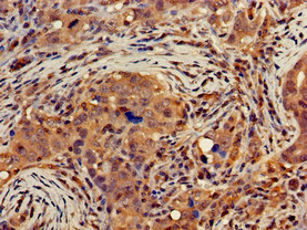DGAT1 Antibody - Immunohistochemistry of paraffin-embedded human pancreatic cancer using DGAT1 Antibody at dilution of 1:100