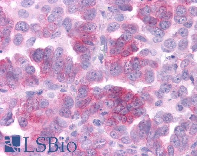 DUSP23 Antibody - Anti-DUSP23 antibody IHC of human Lung, Non-Small Cell Carcinoma. Immunohistochemistry of formalin-fixed, paraffin-embedded tissue after heat-induced antigen retrieval.
