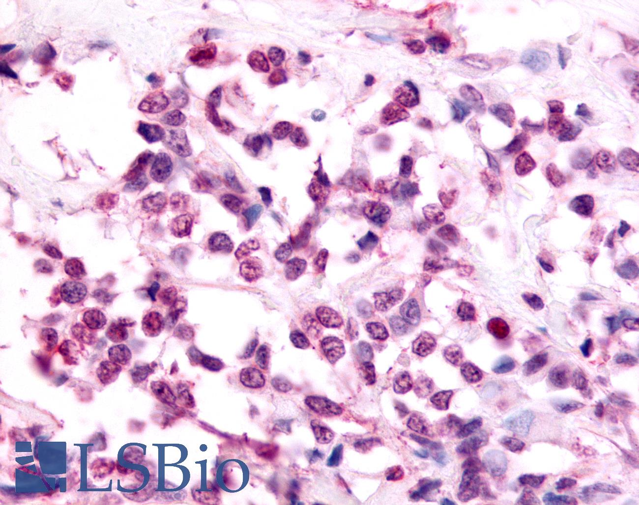 EAR2 / NR2F6 Antibody - Anti-EAR2 / NR2F6 antibody IHC of human Breast, Carcinoma. Immunohistochemistry of formalin-fixed, paraffin-embedded tissue after heat-induced antigen retrieval.