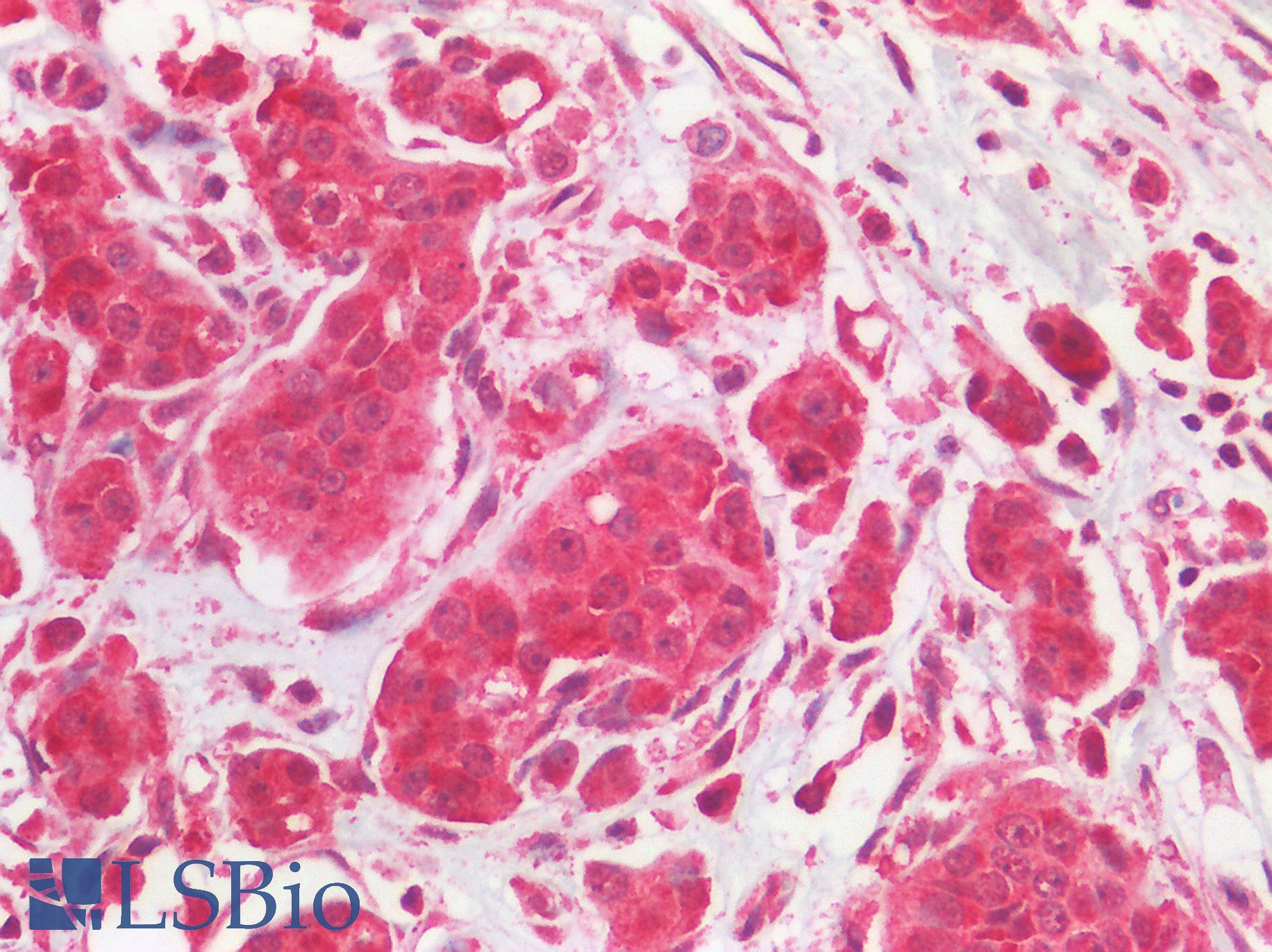 EGFR Antibody - Human Breast Carcinoma: Formalin-Fixed, Paraffin-Embedded (FFPE)