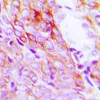 EGFR Antibody - Immunohistochemical analysis of EGFR staining in human breast cancer formalin fixed paraffin embedded tissue section. The section was pre-treated using heat mediated antigen retrieval with sodium citrate buffer (pH 6.0). The section was then incubated with the antibody at room temperature and detected using an HRP-conjugated compact polymer system. DAB was used as the chromogen. The section was then counterstained with hematoxylin and mounted with DPX.