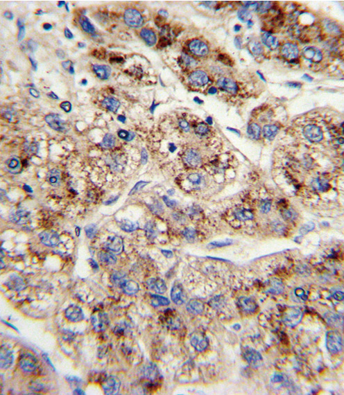 EHHADH / Enoyl-Coa Hydratase Antibody - Formalin-fixed and paraffin-embedded human hepatocarcinoma with EHHADH Antibody , which was peroxidase-conjugated to the secondary antibody, followed by DAB staining. This data demonstrates the use of this antibody for immunohistochemistry; clinical relevance has not been evaluated.