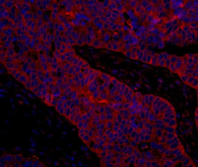 EIF3B Antibody - Detection of Human eIF3B/EIF3S9 by Immunohistochemistry. Sample: FFPE section of human ovarian carcinoma. Antibody: Affinity purified rabbit anti-eIF3B/EIF3S9 used at a dilution of 1:100. Detection: Red-fluorescent Goat anti-Rabbit IgG-heavy and light chain cross-adsorbed Antibody DyLight 594 Conjugated (A120-601D4) used at a dilution of 1:100.