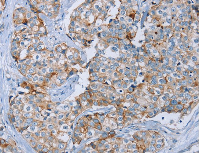 EMA / MUC1 Antibody - Immunohistochemistry of paraffin-embedded Human cervical cancer using MUC1 Polyclonal Antibody at dilution of 1:45.