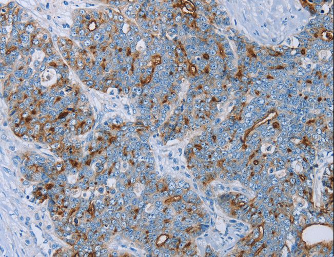 EMA / MUC1 Antibody - Immunohistochemistry of paraffin-embedded Human cervical cancer using MUC1 Polyclonal Antibody at dilution of 1:45.