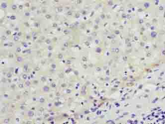 ENOX1 / CNOX Antibody - Immunohistochemistry of paraffin-embedded human liver cancer using antibody at dilution of 1:100.