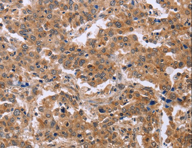 EPDR / EPDR1 Antibody - Immunohistochemistry of paraffin-embedded Human liver cancer using EPDR1 Polyclonal Antibody at dilution of 1:40.