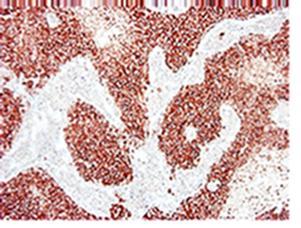 ERBB2 / HER2 Antibody - Immunohistochemistry on paraffin section of human breast carcinoma