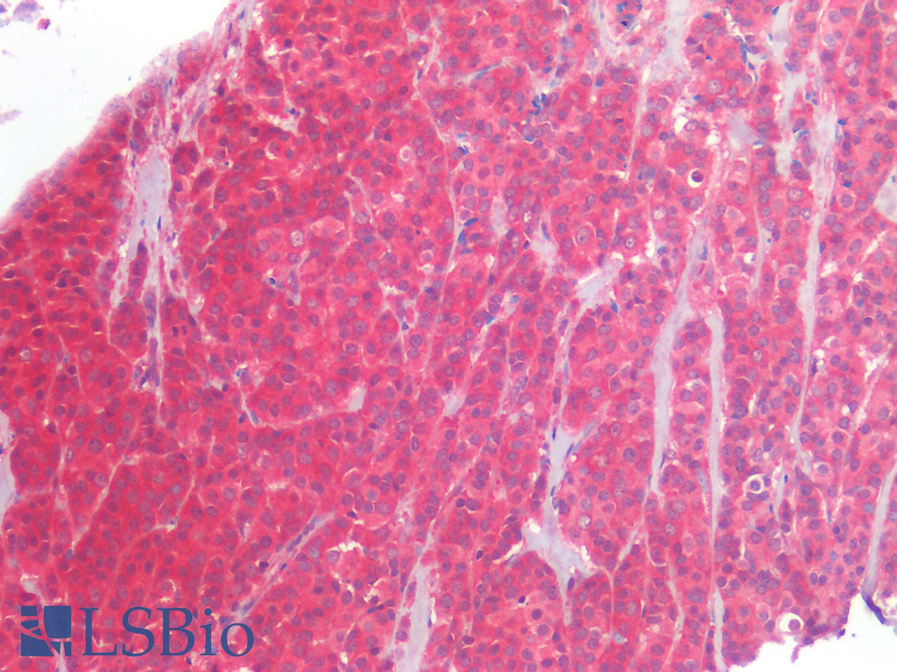 ERBB2 / HER2 Antibody - Human Breast, Carcinoma: Formalin-Fixed, Paraffin-Embedded (FFPE)