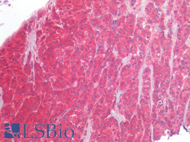 ERBB2 / HER2 Antibody - Human Breast, Carcinoma: Formalin-Fixed, Paraffin-Embedded (FFPE)