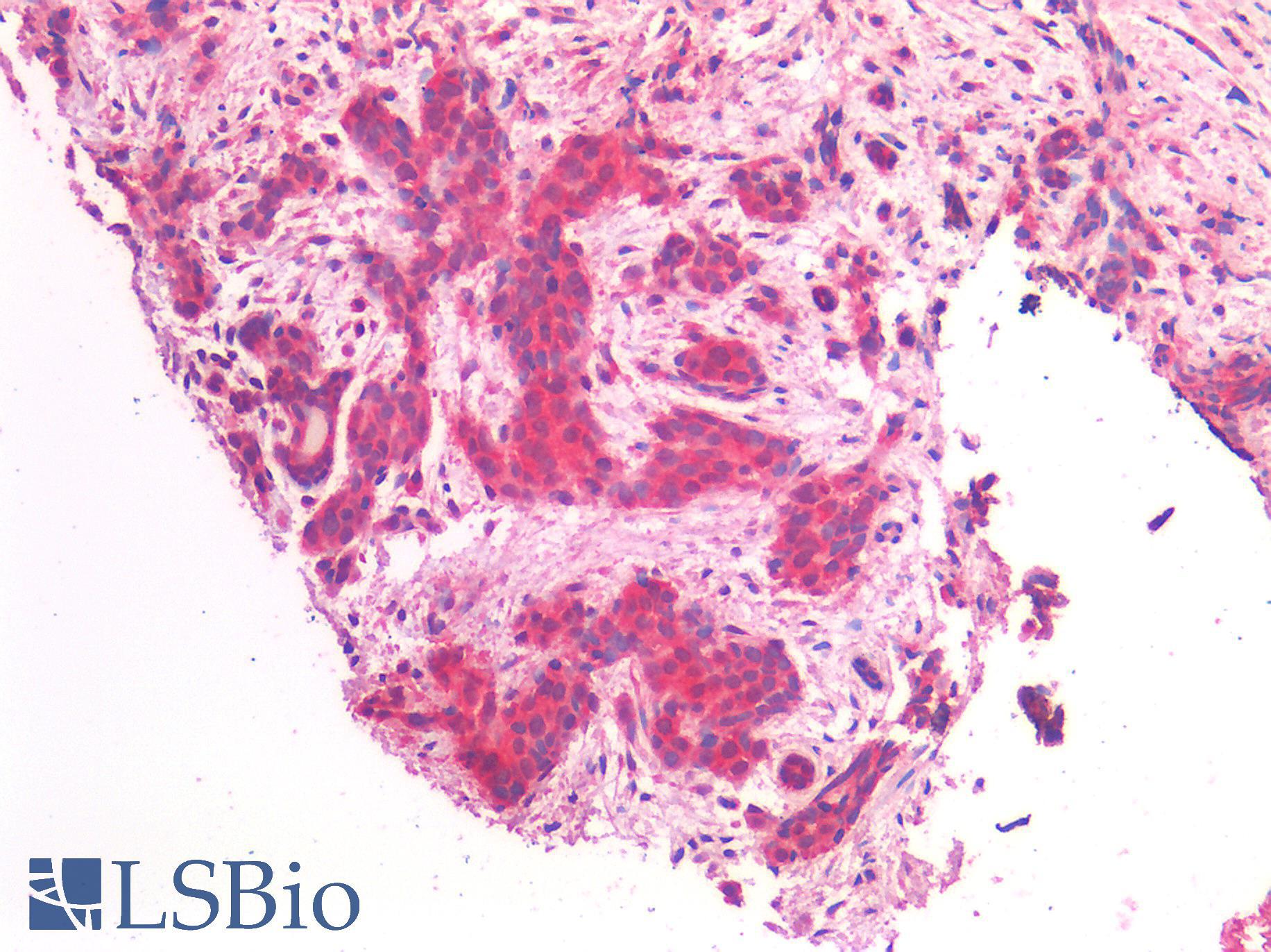 ERBB2 / HER2 Antibody - Human Breast, Carcinoma: Formalin-Fixed, Paraffin-Embedded (FFPE)