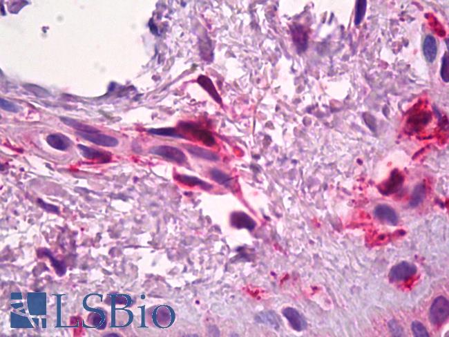 F13A1 / Factor XIIIa Antibody - Anti-F13A1 / Factor XIIIa antibody IHC of human skin, dermal inflammatory cells. Immunohistochemistry of formalin-fixed, paraffin-embedded tissue after heat-induced antigen retrieval. Antibody concentration 3 ug/ml.
