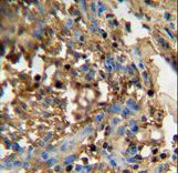 FAM20C Antibody - DMP4 antibody immunohistochemistry of formalin-fixed and paraffin-embedded human breast carcinoma followed by peroxidase-conjugated secondary antibody and DAB staining.