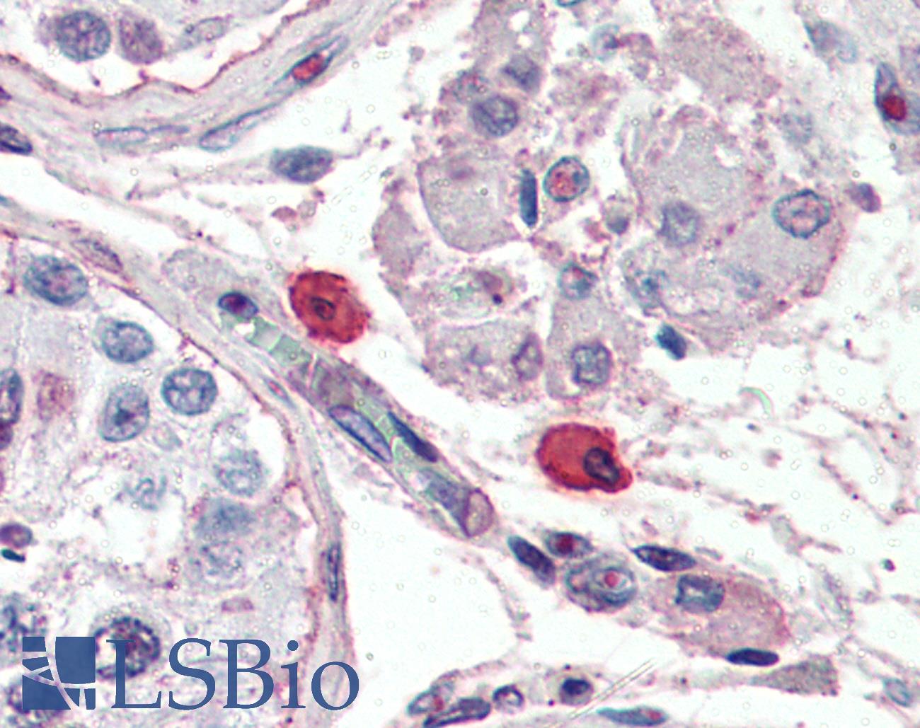FceR1 / Fc Epsilon Receptor 1 Antibody - Anti-FceR1 / Fc Epsilon Receptor 1 antibody IHC of human mast cells. Immunohistochemistry of formalin-fixed, paraffin-embedded tissue after heat-induced antigen retrieval. Antibody concentration 10 ug/ml.  This image was taken for the unconjugated form of this product. Other forms have not been tested.