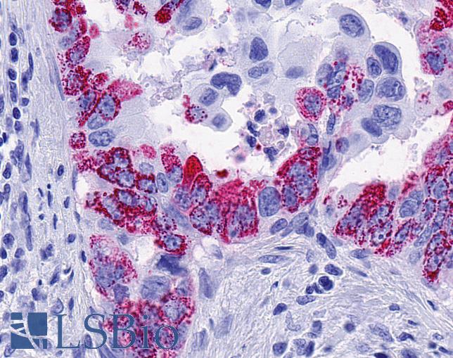 FFAR2 / GPR43 Antibody - Anti-FFAR2 / GPR43 antibody IHC of human Pancreas, Carcinoma. Immunohistochemistry of formalin-fixed, paraffin-embedded tissue after heat-induced antigen retrieval.