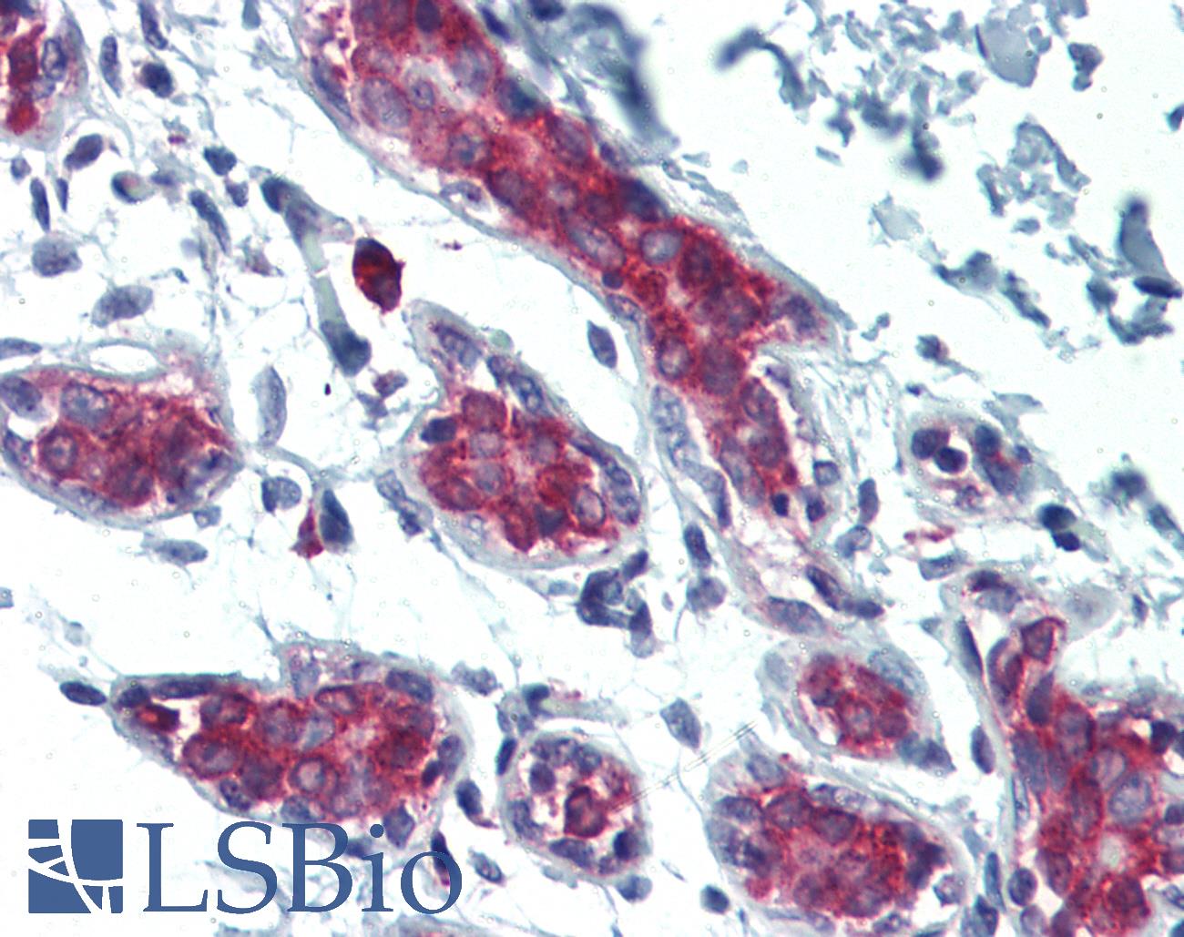 FHIT Antibody - Anti-FHIT antibody IHC of human breast. Immunohistochemistry of formalin-fixed, paraffin-embedded tissue after heat-induced antigen retrieval. Antibody concentration 5 ug/ml.