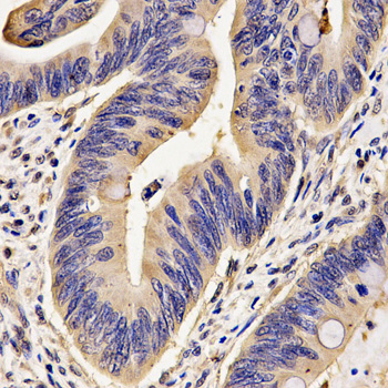 FKBP1A / FKBP12 Antibody - Immunohistochemistry of paraffin-embedded human rectal cancer using FKBP1A antibody at dilution of 1:200 (x400 lens)