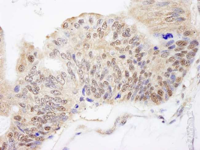 FKBP4 / FKBP52 Antibody - Detection of Human FKBP4/FKBP52 by Immunohistochemistry. Sample: FFPE section of human ovarian carcinoma. Antibody: Affinity purified rabbit anti-FKBP4/FKBP52 used at a dilution of 1:500.