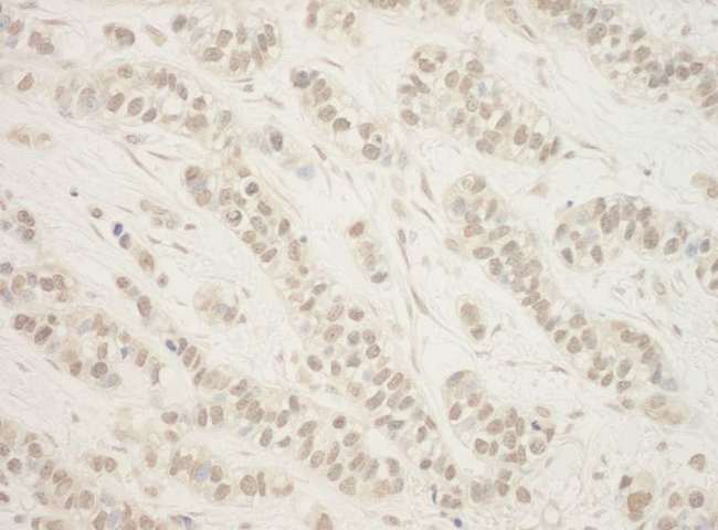 FLCN / Folliculin Antibody - Detection of Human BHD by Immunohistochemistry. Sample: FFPE section of human breast carcinoma. Antibody: Affinity purified rabbit anti-BHD used at a dilution of 1:1000 (1 ug/ml).