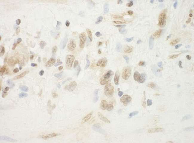FLCN / Folliculin Antibody - Detection of Human BHD by Immunohistochemistry. Sample: FFPE section of human linitis plastica stomach cancer. Antibody: Affinity purified rabbit anti-BHD used at a dilution of 1:250.