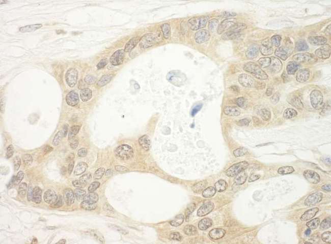 FLCN / Folliculin Antibody - Detection of Human BHD by Immunohistochemistry. Sample: FFPE section of human ovarian carcinoma. Antibody: Affinity purified rabbit anti-BHD used at a dilution of 1:250.