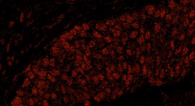 FLJ12529 / CPSF7 Antibody - Detection of Human CPSF59 by Immunofluorescence. Sample: FFPE section of human breast carcinoma. Antibody: Affinity purified rabbit anti-CPSF59 used at a dilution of 1:100. Detection: Red-fluorescent goat anti-rabbit IgG highly cross-adsorbed Antibody used at a dilution of 1:100.