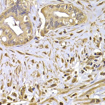 FSCN1 / Fascin Antibody - Immunohistochemistry of paraffin-embedded human liver cancer using FSCN1 antibody at dilution of 1:100 (x400 lens).