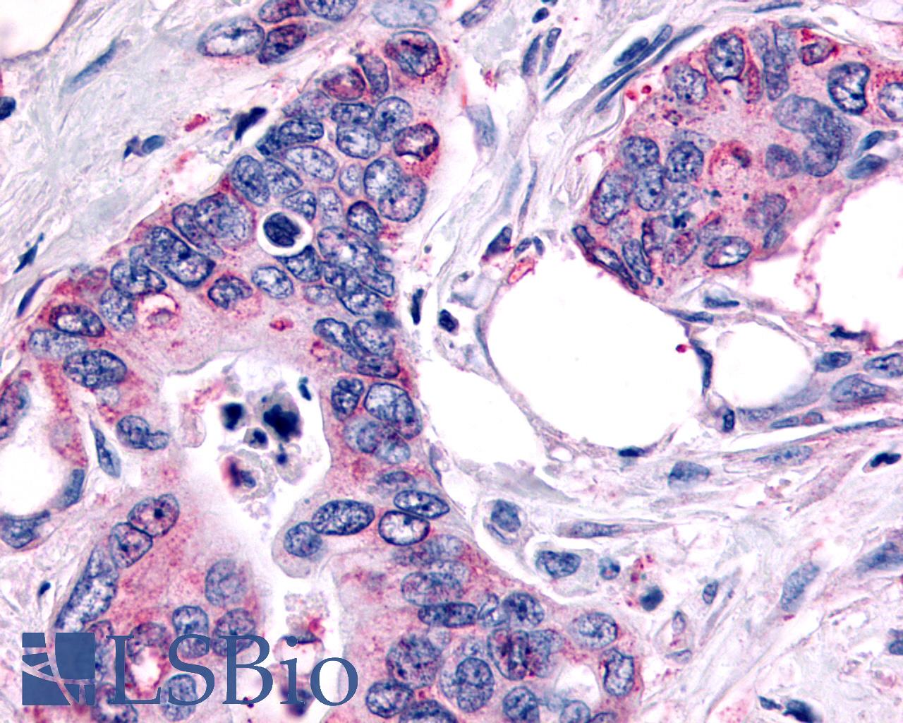 FZD10 / Frizzled 10 Antibody - Anti-FZD10 / Frizzled 10 antibody IHC of human Pancreas, Carcinoma. Immunohistochemistry of formalin-fixed, paraffin-embedded tissue after heat-induced antigen retrieval.