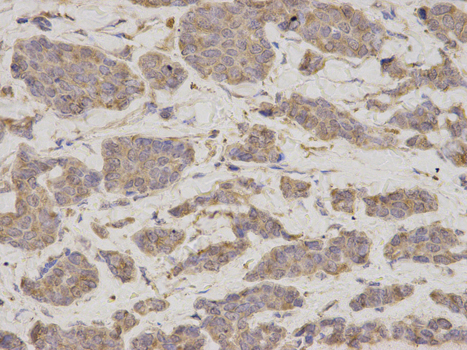 GDI1 Antibody - Immunohistochemistry of paraffin-embedded human breast cancer using GDI1 antibody at dilution of 1:200 (400x lens).