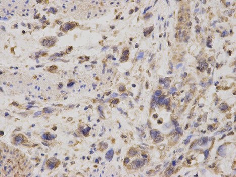 GDI1 Antibody - Immunohistochemistry of paraffin-embedded human stomach cancer using GDI1 antibody at dilution of 1:200 (400x lens).