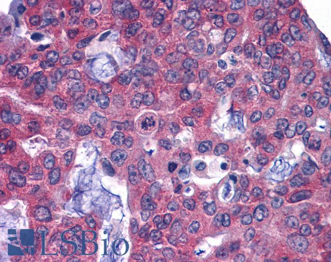GFPT1 / GFAT Antibody - Anti-GFPT1 / GFAT antibody IHC of human Colon, Carcinoma. Immunohistochemistry of formalin-fixed, paraffin-embedded tissue after heat-induced antigen retrieval.