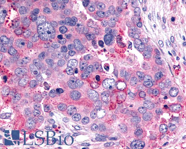 GHRHR Antibody - Anti-GHRHR antibody IHC of human Ovary, Carcinoma. Immunohistochemistry of formalin-fixed, paraffin-embedded tissue after heat-induced antigen retrieval.
