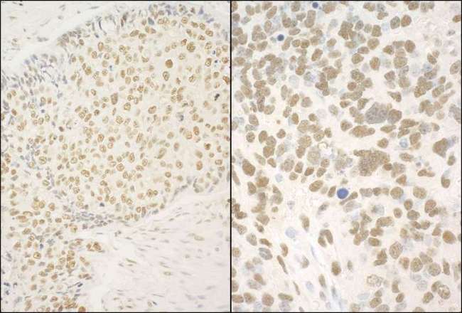 GMEB1 Antibody - Detection of Human and Mouse GMEB1 by Immunohistochemistry. Sample: FFPE section of human lung carcinoma (left) and mouse teratoma (right). Antibody: Affinity purified rabbit anti-GMEB1 used at a dilution of 1:1000 (0.2 Detection: DAB.