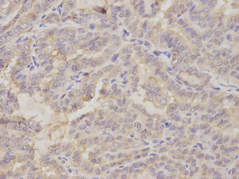 GOLGA2 / GM130 Antibody - Immunohistochemistry of paraffin-embedded human thyroid cancer using GOLGA2 antibody at dilution of 1:200 (400x lens).
