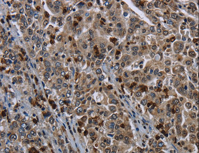GP1BA / CD42b Antibody - Immunohistochemistry of paraffin-embedded Human liver cancer using GP1BA Polyclonal Antibody at dilution of 1:50.