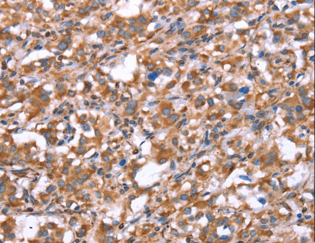 GPC6 / Glypican 6 Antibody - Immunohistochemistry of paraffin-embedded Human gastric cancer using GPC6 Polyclonal Antibody at dilution of 1:40.