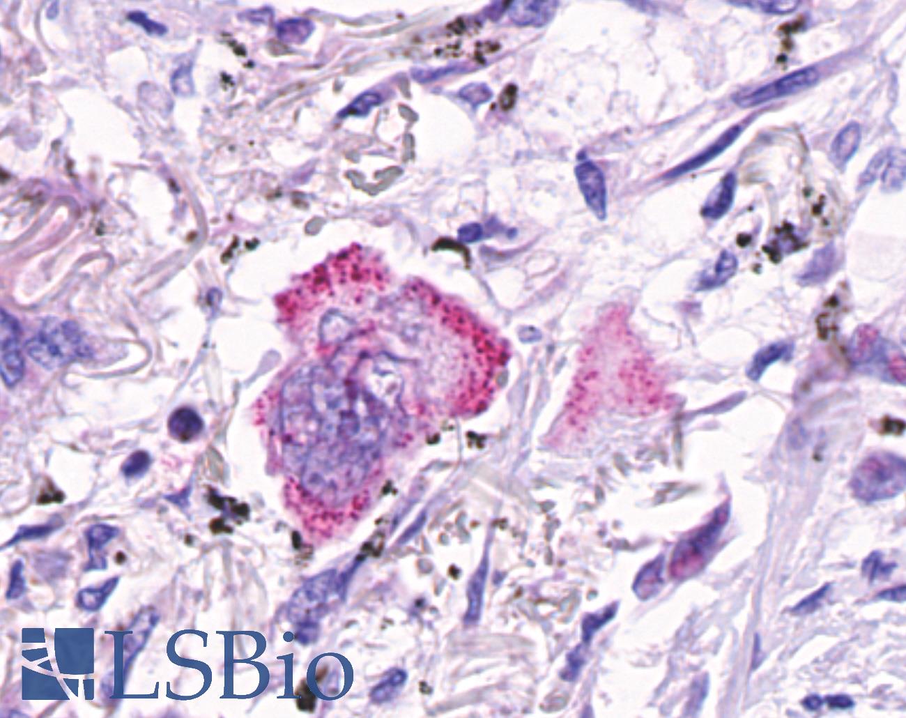 GPR48 / LGR4 Antibody - Anti-GPR48 / LGR4 antibody IHC of human Lung, Adenocarcinoma. Immunohistochemistry of formalin-fixed, paraffin-embedded tissue after heat-induced antigen retrieval.