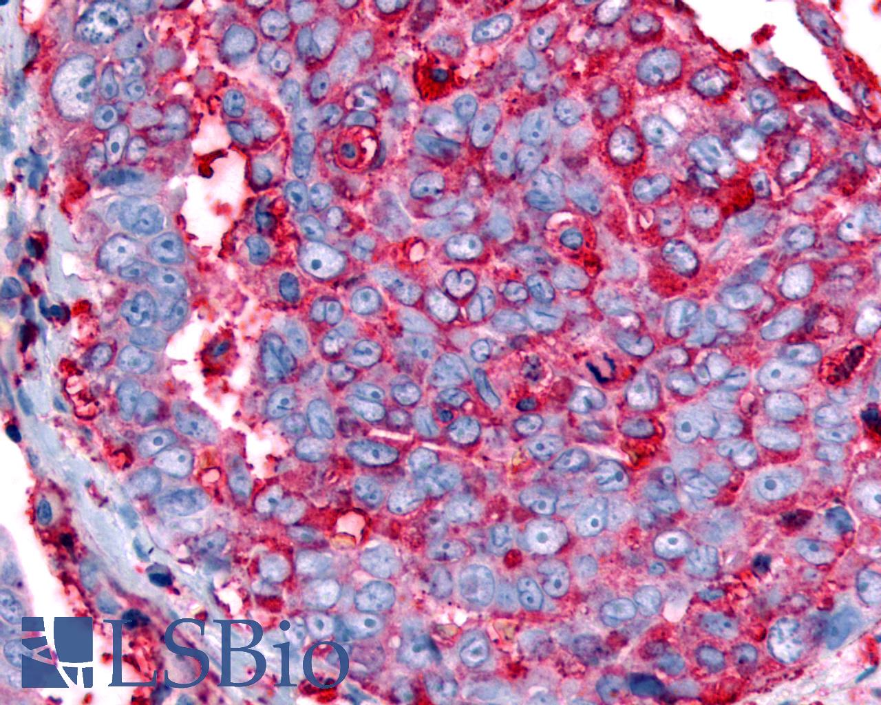 GPR63 Antibody - Anti-GPR63 antibody IHC of human Ovary, Carcinoma. Immunohistochemistry of formalin-fixed, paraffin-embedded tissue after heat-induced antigen retrieval.