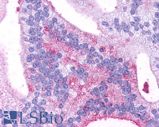 GPR88 Antibody - Anti-GPR88 antibody IHC of human Prostate, Carcinoma. Immunohistochemistry of formalin-fixed, paraffin-embedded tissue after heat-induced antigen retrieval.