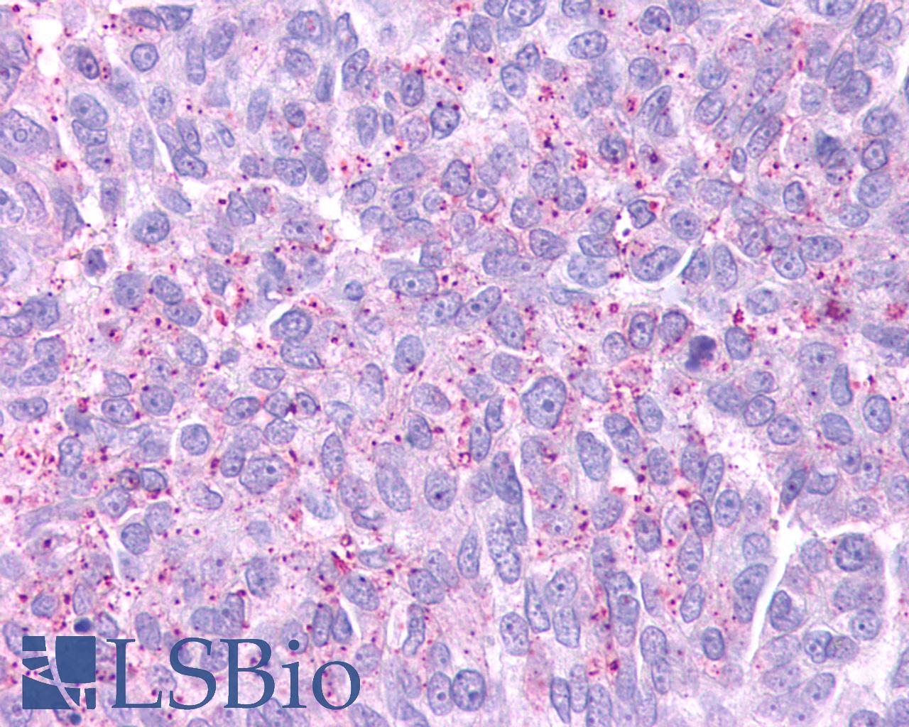 GPR88 Antibody - Anti-GPR88 antibody IHC of human Ovary, Carcinoma. Immunohistochemistry of formalin-fixed, paraffin-embedded tissue after heat-induced antigen retrieval.