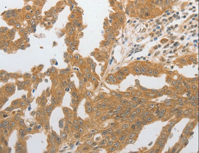 GRIN2C / NMDAR2C / NR2C Antibody - Immunohistochemistry of paraffin-embedded Human ovarian cancer using GRIN2C Polyclonal Antibody at dilution of 1:80.