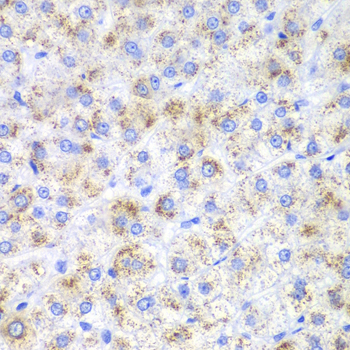HAO1 Antibody - Immunohistochemistry of paraffin-embedded human liver cancer tissue.