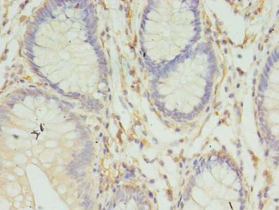 HLA-DRB4 Antibody - Immunohistochemistry of paraffin-embedded human colon cancer using antibody at dilution of 1:100.