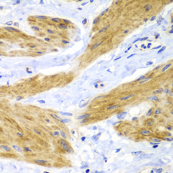 HRAS / H-Ras Antibody - Immunohistochemistry of paraffin-embedded human gastric cancer tissue.